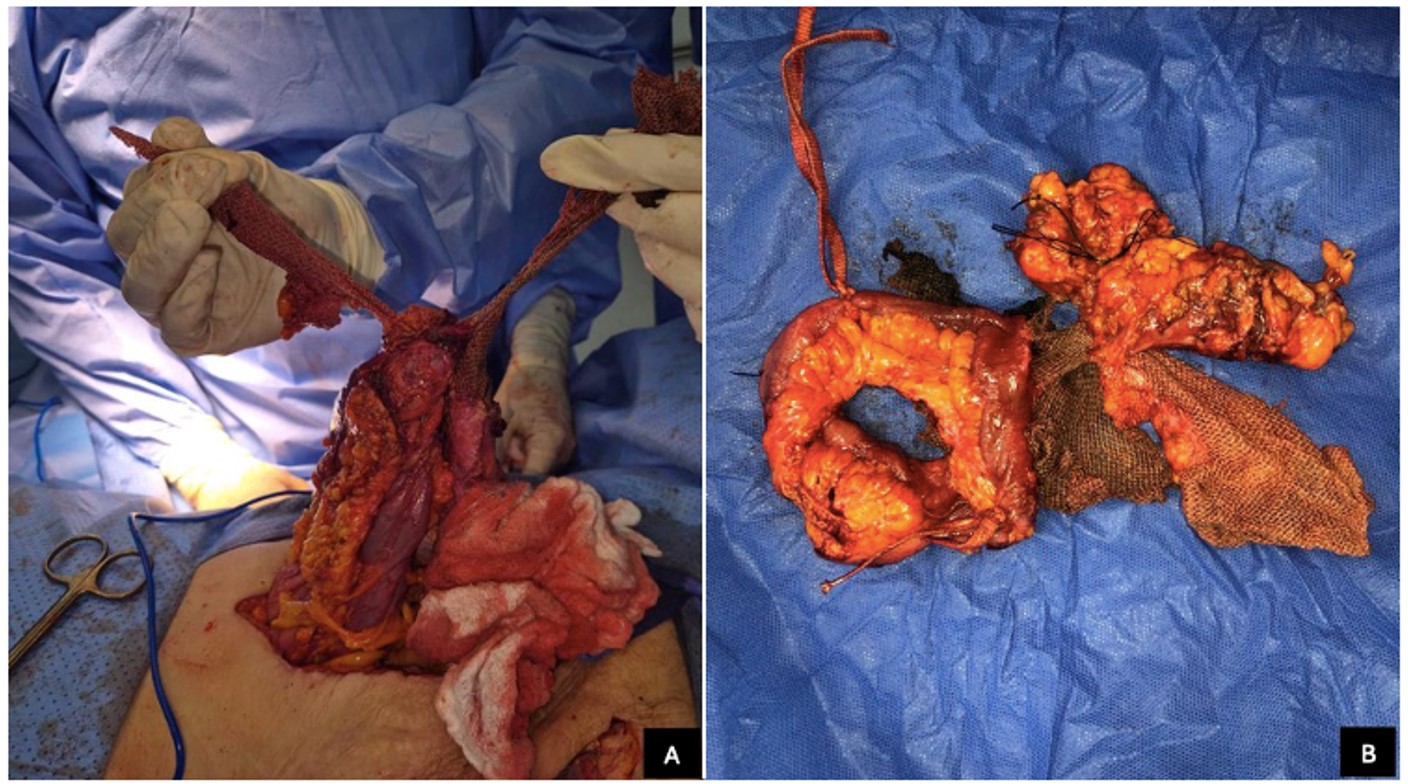 Intraoperative image of exploratory laparotomy showing evidence of late mesh migration. (A) Intraoperative findings during the initial exploratory laparotomy evidenced fused surgical mesh between the transverse colon and distal ileum, with signs of severe inflammation and enterocolic fistula formati