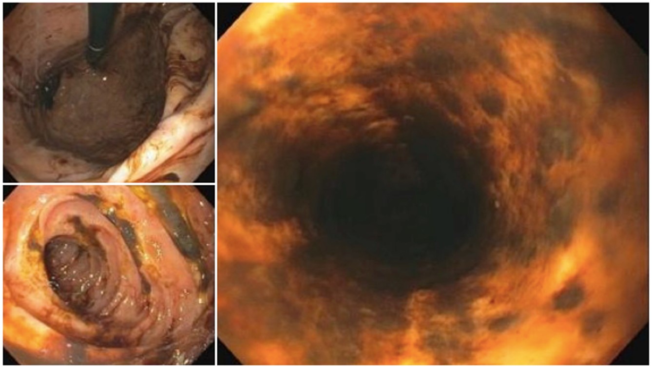 Upper endoscopy images show acute necrotic esophagitis ("black esophagus"), erosive erythematous pangastropathy, and necrotic erosive duodenitis.