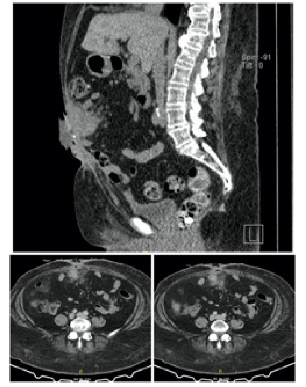 Contrast abdominal computed tomography (axial and sagittal sections) demonstrated an enteric fistula with significant striation of the adjacent peritoneal fat.