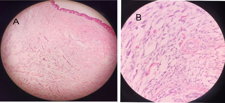 (A) Low-power view shows an unencapsulated, poorly circumscribed dermal lesion beneath an intact epidermis, composed of a diffuse spindle-cell proliferation infiltrating between and splitting collagen bundles (original magnification: 40x H&E). (B) Higher-power view shows fascicles and scattered sing