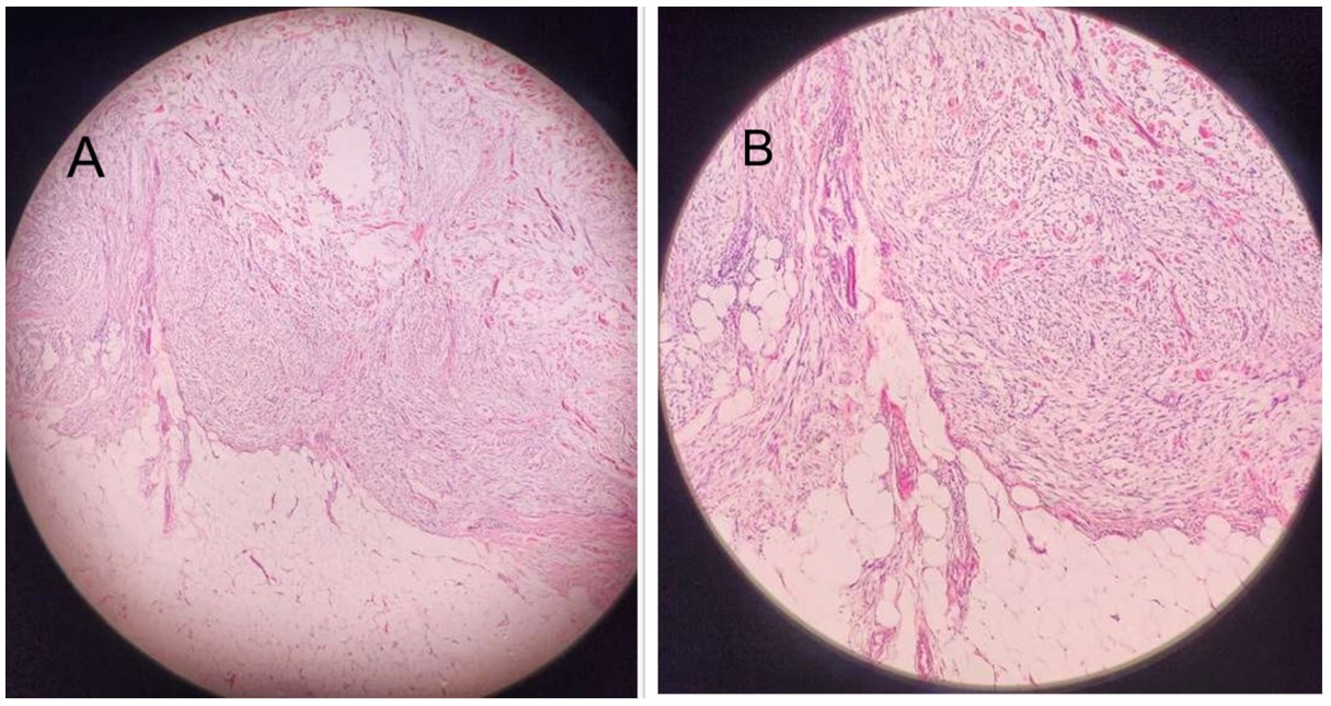 (A) Infiltrative growth at periphery (original magnification:100x H&E). (B) Higher magnification (original magnification: 200x H&E).