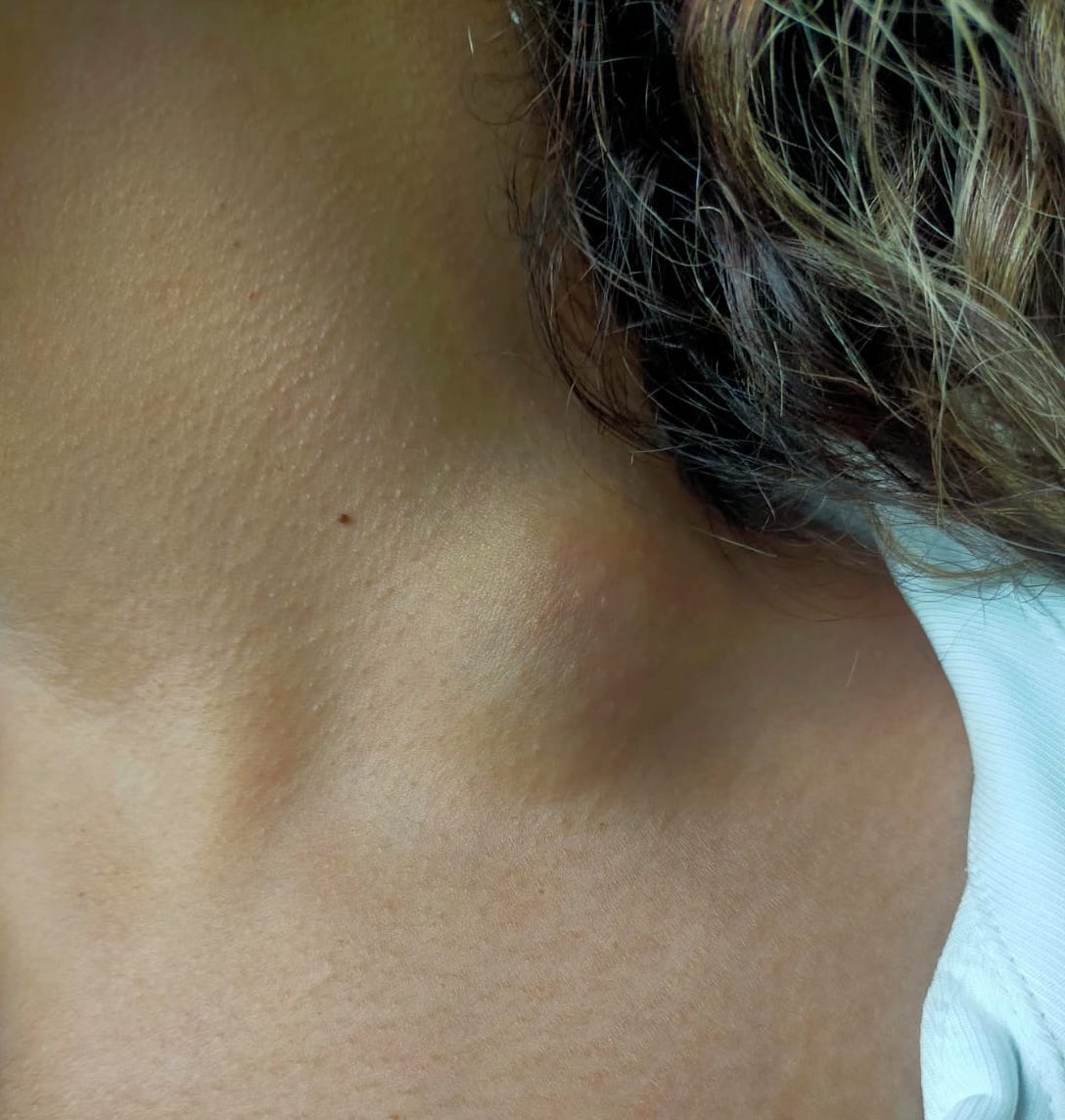 Clinical appearance of the left external jugular vein pseudoaneurysm. Non-pulsatile and tender mass in the left jugular region.