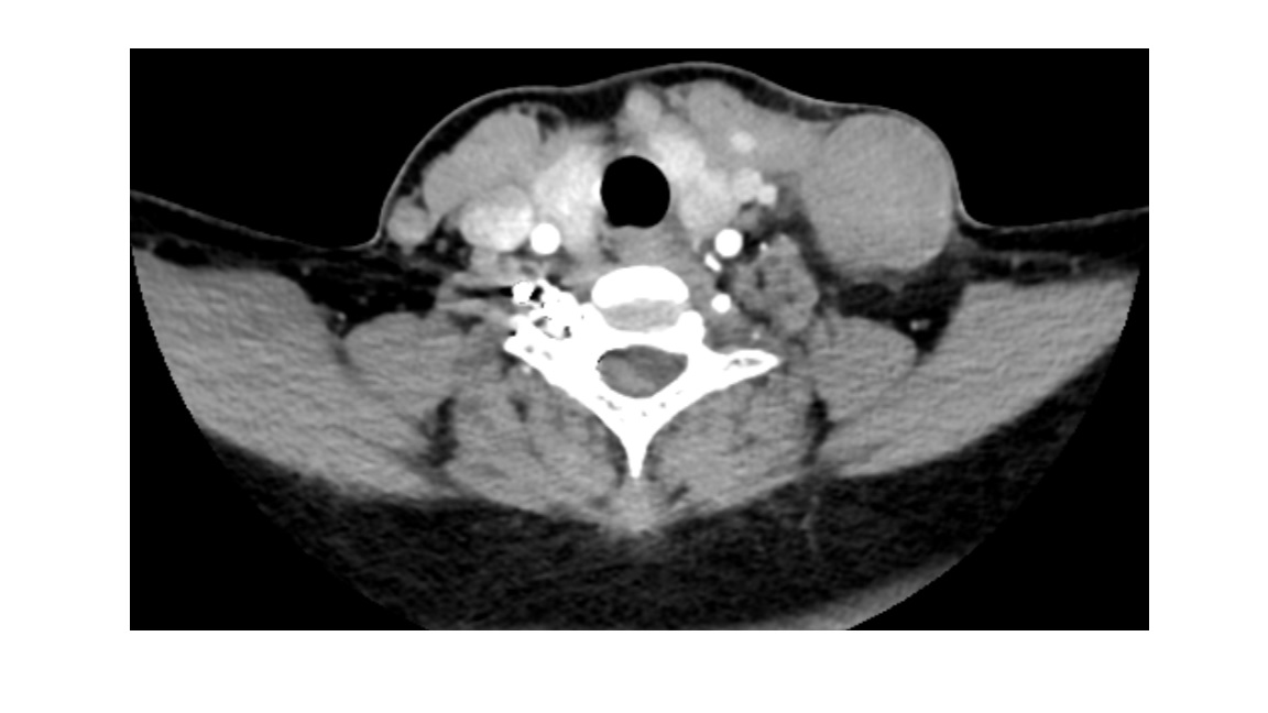 Appearance of the jugular vein pseudoaneurysm by CT angiography. Imaging demonstrated a thrombosed saccular pseudoaneurysm arising from the left external jugular vein, measuring 30 × 20 mm, without arterial communication.