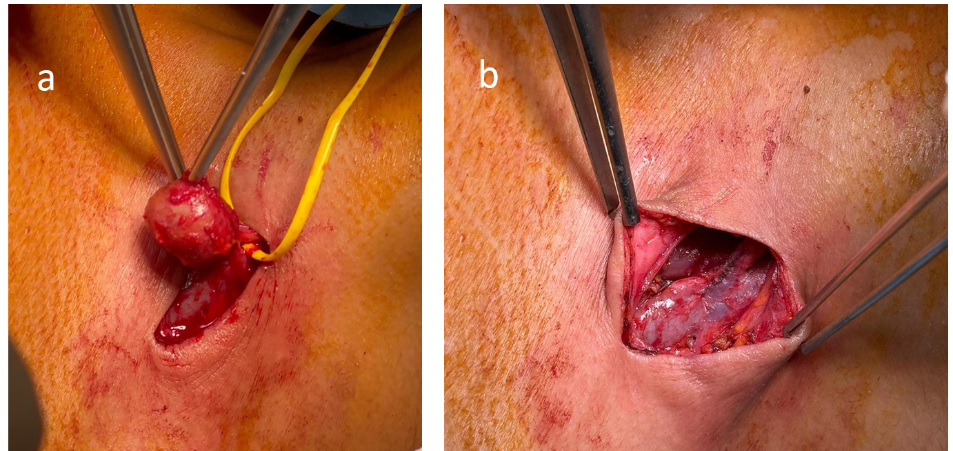 (a) Perioperative view of the pseudoaneurysm; (b) Perioperative view of the jugular vein following pseudoaneurysm resection and primary suture repair of the jugular vein.