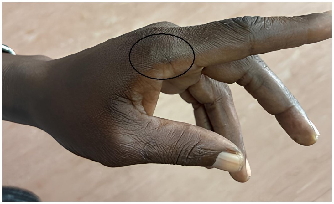 Healed fang marks three weeks after envenomation, demonstrating minimal local tissue damage despite profound systemic coagulopathy.
