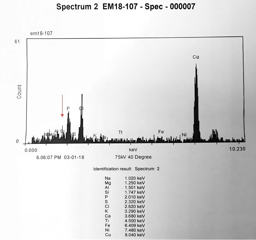 SEM-EDS Elemental Analysis of Liver Granulomatous Reaction Demonstrating Silicon Signal. Scanning electron microscopy with energy-dispersive X-ray spectroscopy (SEM-EDS) performed on liver biopsy tissue showing non-necrotizing granulomatous inflammation. The elemental spectrum shows a silicon (Si) p