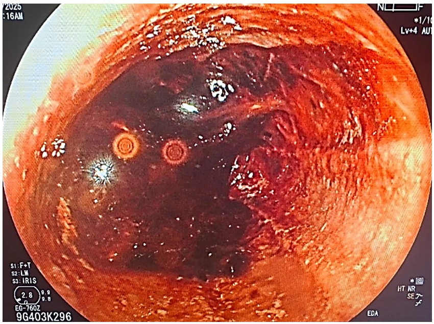 First Upper Gastrointestinal Endoscopy. Abundant blood debris obscuring visualization of esophageal mucosa.