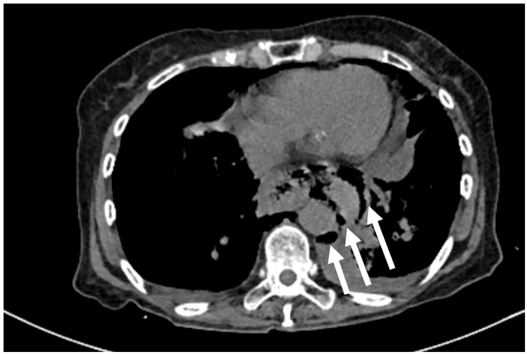 Chest CT Scan. Presence of extraluminal air in the posterior mediastinum (white arrows) suggestive of esophageal wall discontinuity, indicative of pneumatosis of the esophageal wall and pneumomediastinum.