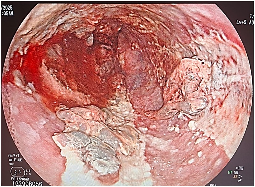 Second Upper Gastrointestinal Endoscopy. The esophageal mucosa shows extensive areas covered by whitish debris and an area of bleeding corresponding to the esophageal perforation.