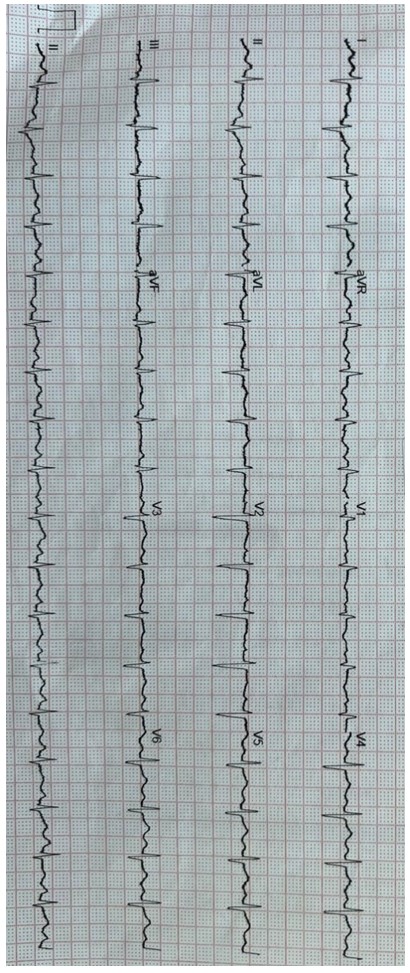 ECG showing sinus tachycardia with S1Q3T3 pattern (prominent S wave in I, Q wave in III, and negative T wave in III).