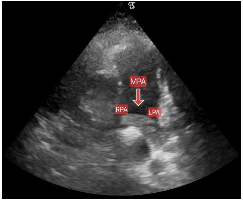 Echocardiography showing dilatation of the main pulmonary artery (MPA) and thrombus occluding the left pulmonary artery (LPA) with partial right pulmonary artery (RPA) obstruction.