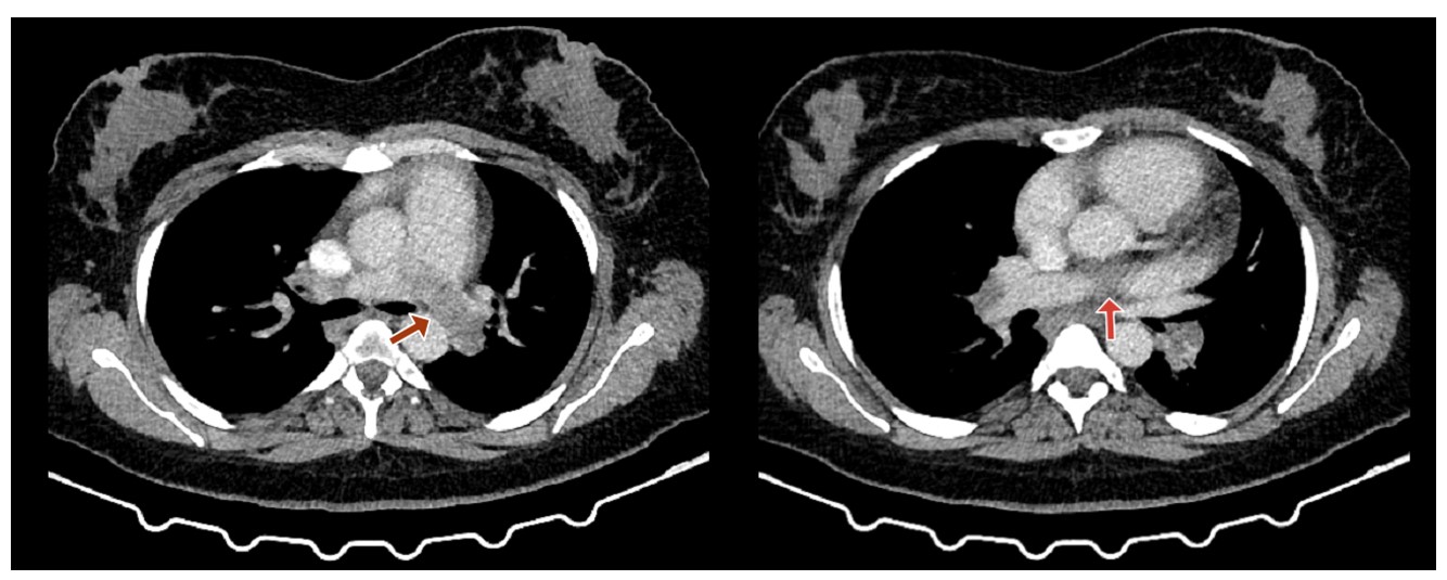 CT angiography of pulmonary vasculature showing filling defects (low attenuation areas) in both the right and left pulmonary arteries, consistent with pulmonary embolism (PE).