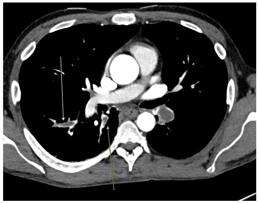 Bilateral lower lobe pulmonary emboli seen on the initial CT scan Abdomen/Pelvis.