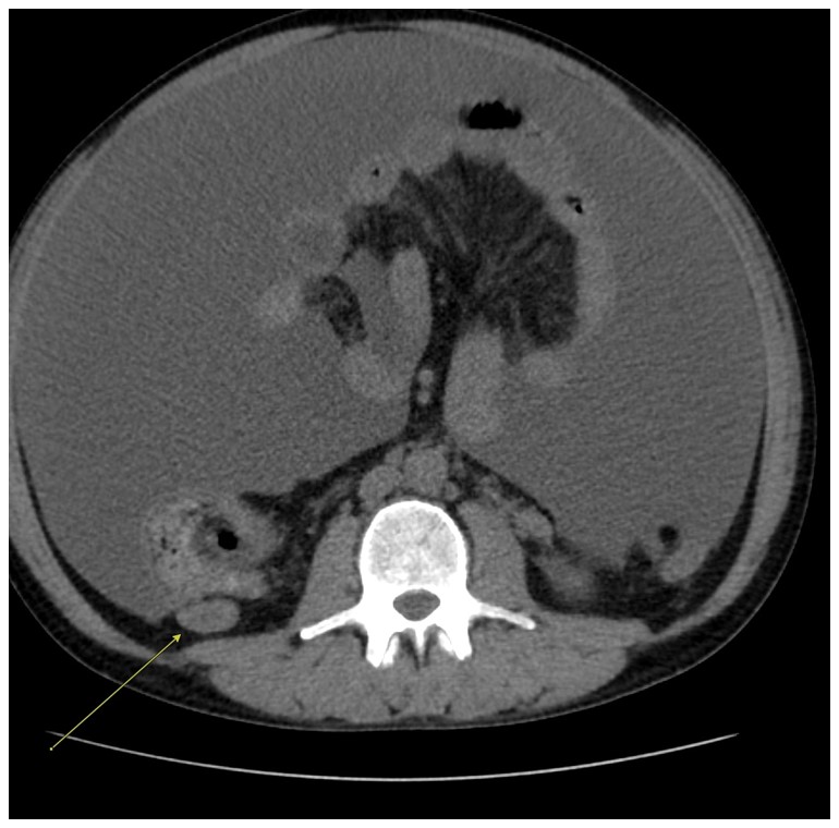 A retroperitoneal lymph node measuring 2.4 cm seen on the initial CT scan Abdomen Pelvis.
