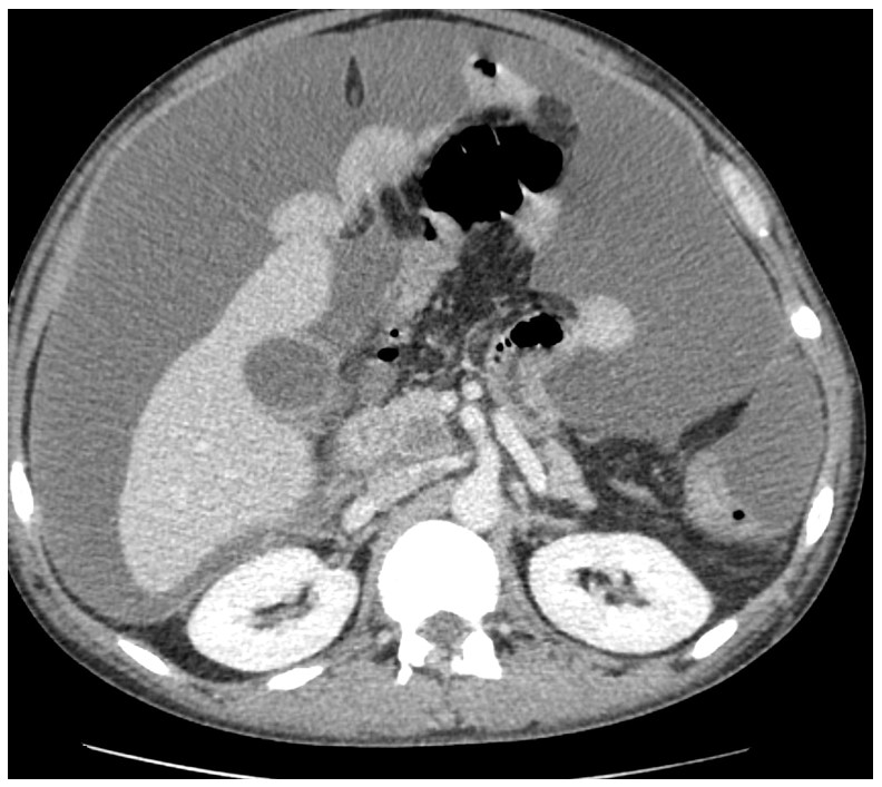 Hypoenhancing 1.8 cm nodule within the pancreatic uncinate seen on the initial CT scan, Abdomen Pelvis.