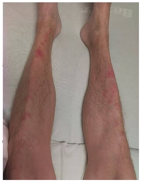 Multiple red, firm, and non-tender nodules on the patient’s lower extremities