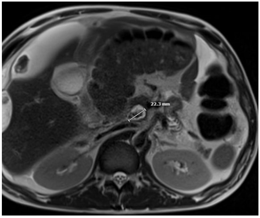 Magnetic Resonance Cholangiopancreatography (MRCP) shows a cystic structure at the uncinate process that appears bilobed, measures up to 4.7 × 2.3 × 3.0 cm , and contains T2 hypointense irregularly shaped filling defects measuring up to 1.2 cm.