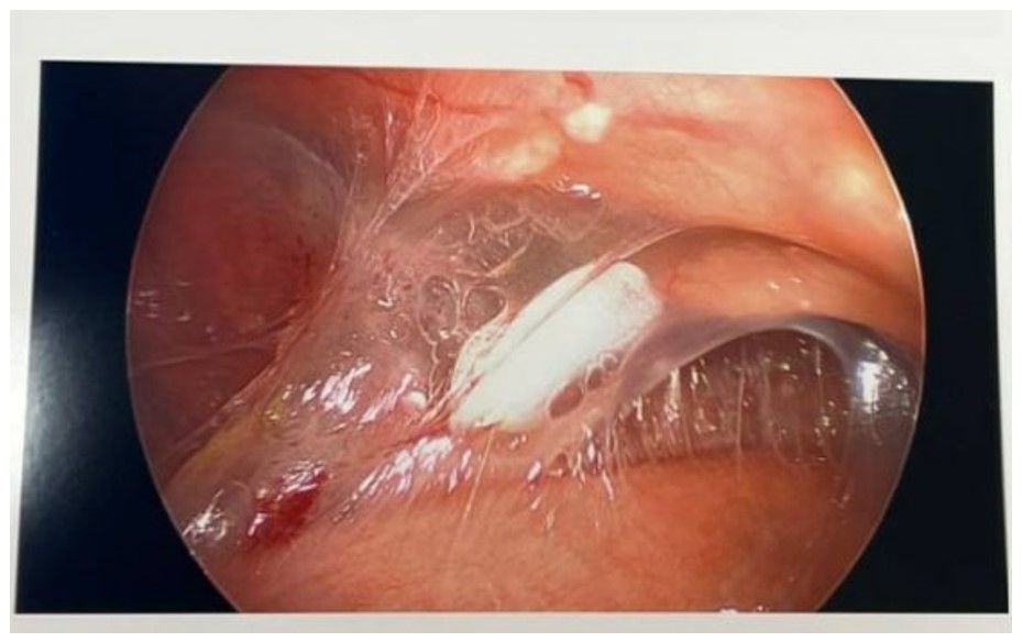 Diagnostic laparoscopy shows copious, filmy adhesions tethering the bowel to the abdominal wall.