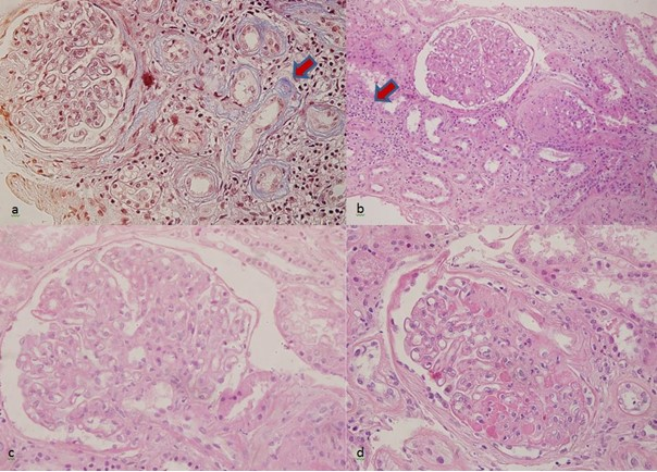 Light microscopy findings showing (a) tubular atrophy and peritubular fibrosis, Masson Trichrome stain × 200; (b) interstitial inflammation H&E × 200; (c) glomerular lobulation and mesangial proliferation, H&E × 400; (d) glomerular fibrin microthrombi H&E × 400.