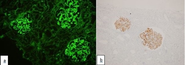 Light microscopy findings showing (a) tubular atrophy and peritubular fibrosis, Masson Trichrome stain × 200; (b) interstitial inflammation H&E × 200; (c) glomerular lobulation and mesangial proliferation, H&E × 400; (d) glomerular fibrin microthrombi H&E × 400.