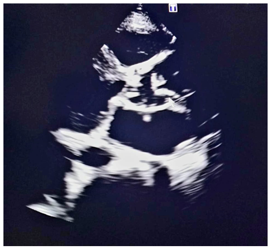 Shows a dilated aortic root and ascending aorta with an echogenic mass on the aortic valve, suggestive of vegetation and dilated LV, likely due to severe aortic regurgitation.