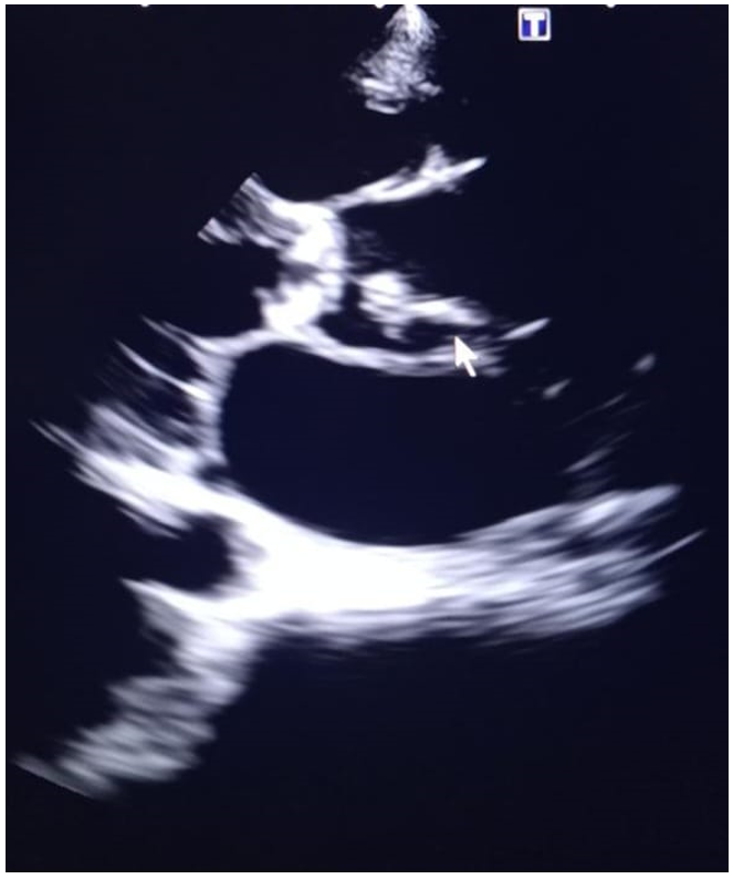 Shows an intimal flap in the ascending aorta and associated aortic root dilation.