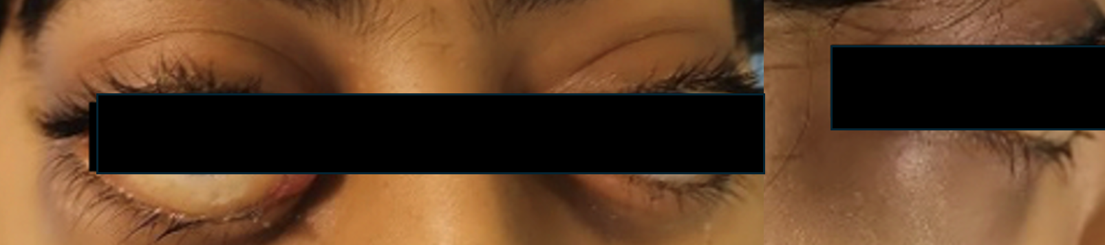 Ophthalmology findings at the initial visit showed bilateral ocular proptosis, more prominently on the right eye, with lid retraction (Left). The side view displays ocular proptosis (Right).