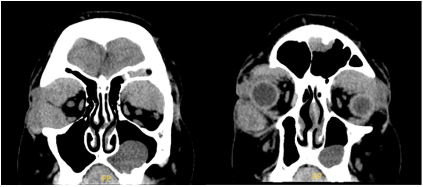 Sagittal view displaying poor definition of the superior and lateral recti muscles of both orbits, particularly prominent on the right orbit secondary to leukemic cell infiltration in a child with acute myeloid leukemia.