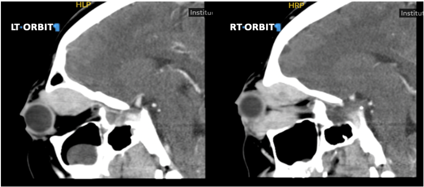 CT Left (LT) and Right (RT) Orbit Sella showing bilateral orbital enhancing infiltrative soft tissue lesions with subsequent bilateral proptosis of eye globes, particularly the right globe.
