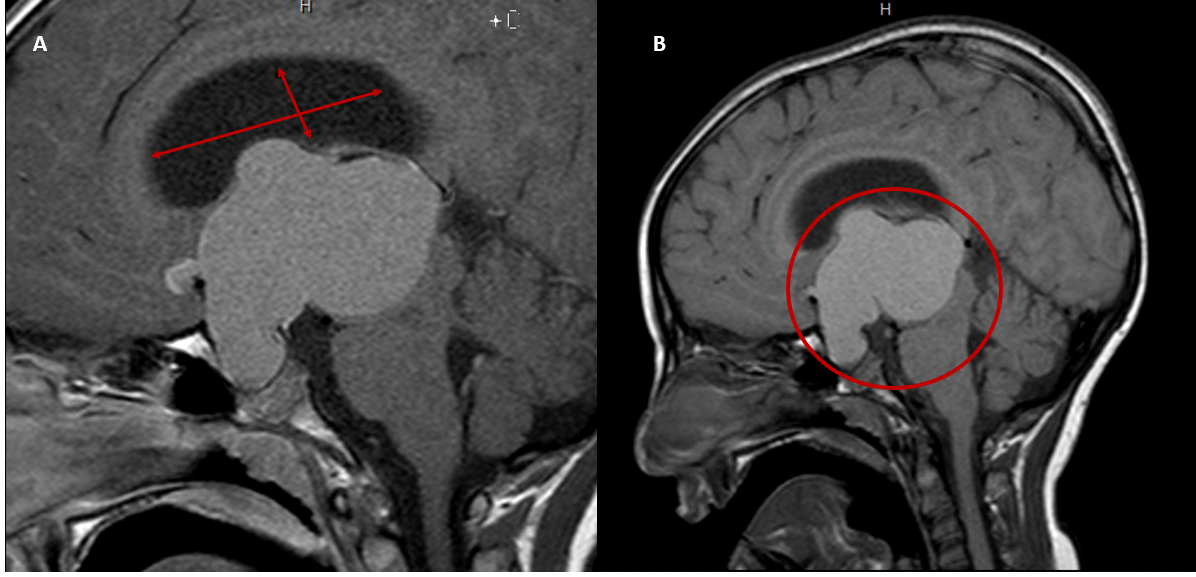 Presurgical sagittal views of MRI brain with contrast demonstrating a lobulated homogeneous mass in the suprasellar region. Mass appears moderately hyperintense on T1, measuring 47 x 64 mm (right panel). Post contrast view (left panel) demonstrates a thin enhancing rim but not significant enhancemen