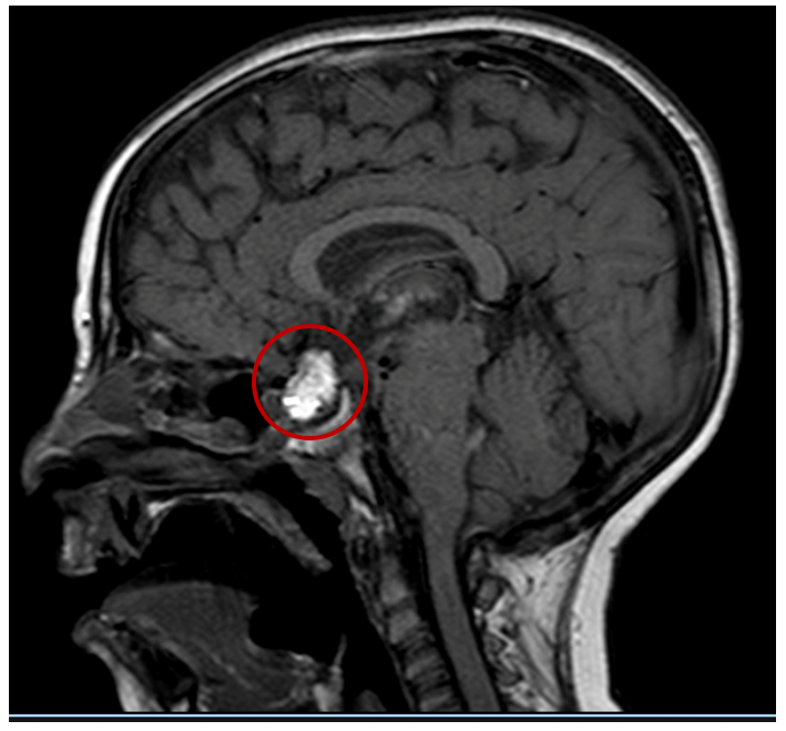 Post-transsphenoidal removal of Craniopharyngioma, sagittal views of MRI brain with contrast demonstrating a 13 x 21 mm organized blood clot at the place of completely resected tumor. Appearing to have high signal intensity on both pre- and post-contrast T1 sequences (right and left panels, respecti