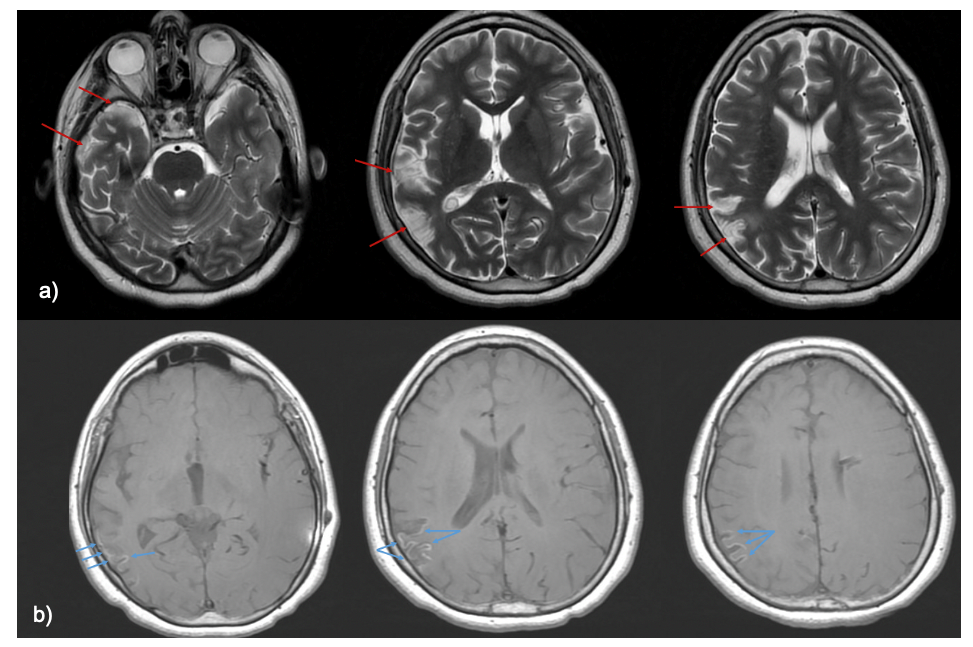 Overall stable findings with chronic changes in the surgical bed, there is a right posterior lateral temporal parietal region localized cortical T2 hyperintense signal with encephalomalacia (panels labelled "a", red arrows) and diffuse gyral T1 hyperintense signal compatible with laminar necrosis (p