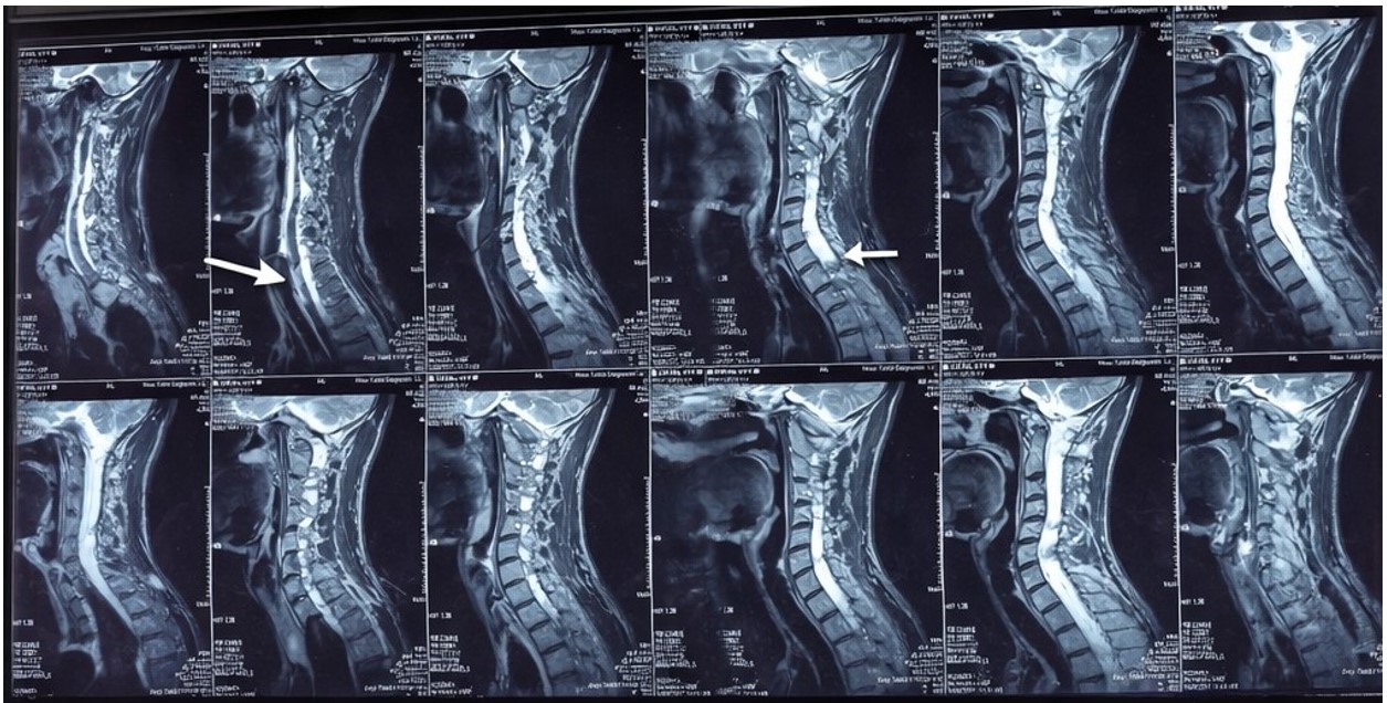 Sagittal T2-weighted magnetic resonance imaging (MRI) of the cervicothoracic spine demonstrating long-segment intramedullary signal change extending from the cervicomedullary junction to T11 (upper arrow), with cystic expansion of the cord and multiple intramedullary nodules consistent with hemangio
