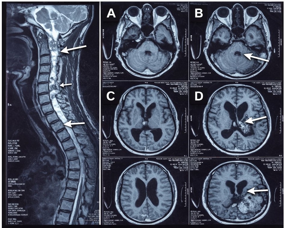 Composite MRI panel demonstrating intracranial and spinal cord findings. (A) Axial T2-weighted brain MRI at the level of the posterior medulla demonstrating an intramedullary lesion producing mass effect on the fourth ventricle with upstream obstructive hydrocephalus (arrow). (B) Axial T2-weighted b