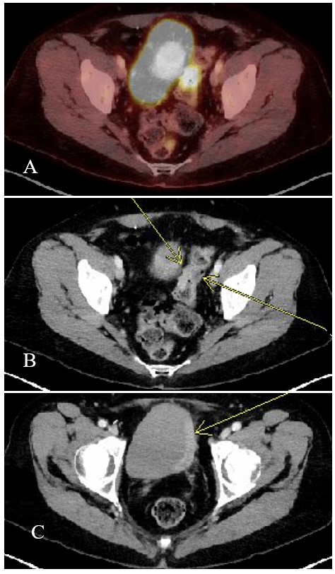 FDG-PET/CT demonstrating synchronous metastatic involvement of the sigmoid colon and urinary bladder. (A, B) Axial PET/CT images demonstrate intense fluorodeoxyglucose uptake within the mid-sigmoid colon corresponding to focal bowel wall thickening. (C) A separate axial image demonstrates marked flu