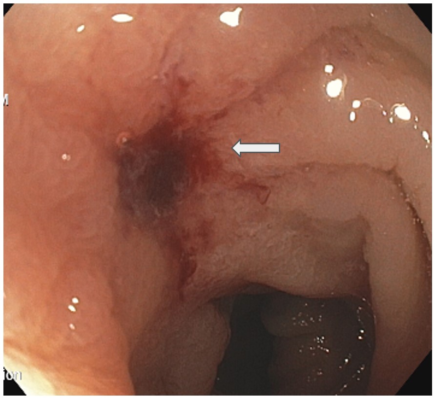 Endoscopic appearance of metastatic invasive lobular breast carcinoma in the sigmoid colon (white arrow).