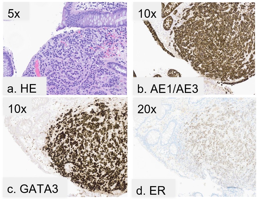 Histopathologic and immunohistochemical features of metastatic invasive lobular breast carcinoma involving the colon. (A) Hematoxylin and eosin (HE) staining demonstrates a poorly cohesive malignant infiltrate within the colonic submucosa at 5x magnification. (B) Cytokeratin AE1/AE3 immunostaining h