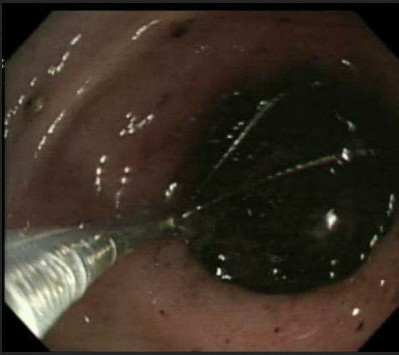 Endoscopic picture 